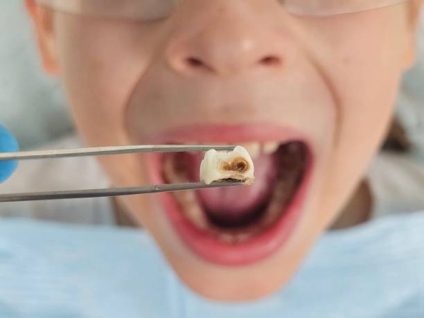 Best Emergency Treatment for Toothache in Superior, AZ